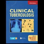 Clinical Tuberculosis   With Access