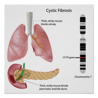 Cystic fibrosis Poster